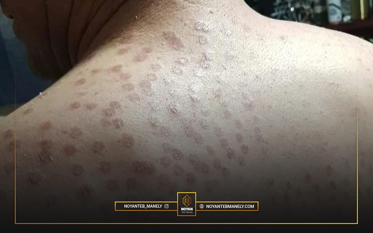 عوارض لیزر برای موهای زائد