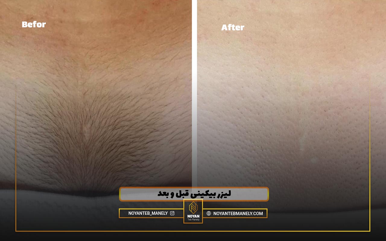 لیزر موهای زائد واژن