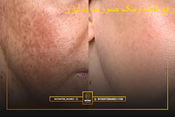درمان کک ومک صورت با لیزر کیوسوئیچ