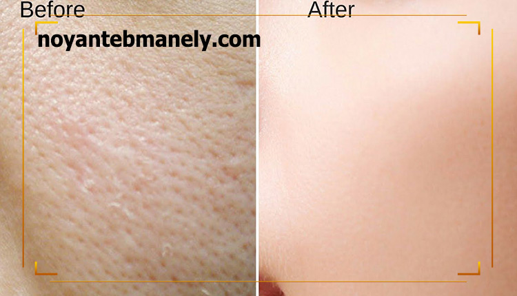 روش های درمان منافذ باز پوست چرب