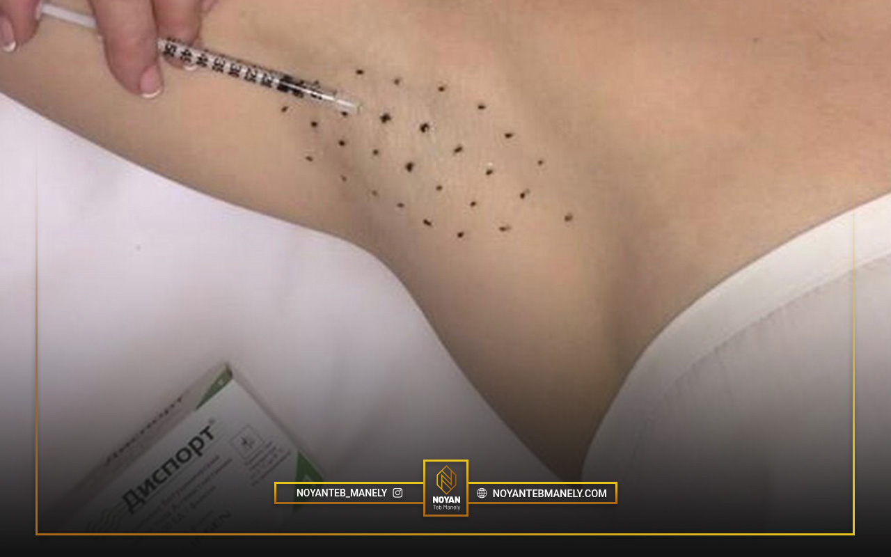 underarm botox injection 1 بوتاکس زیر بغل