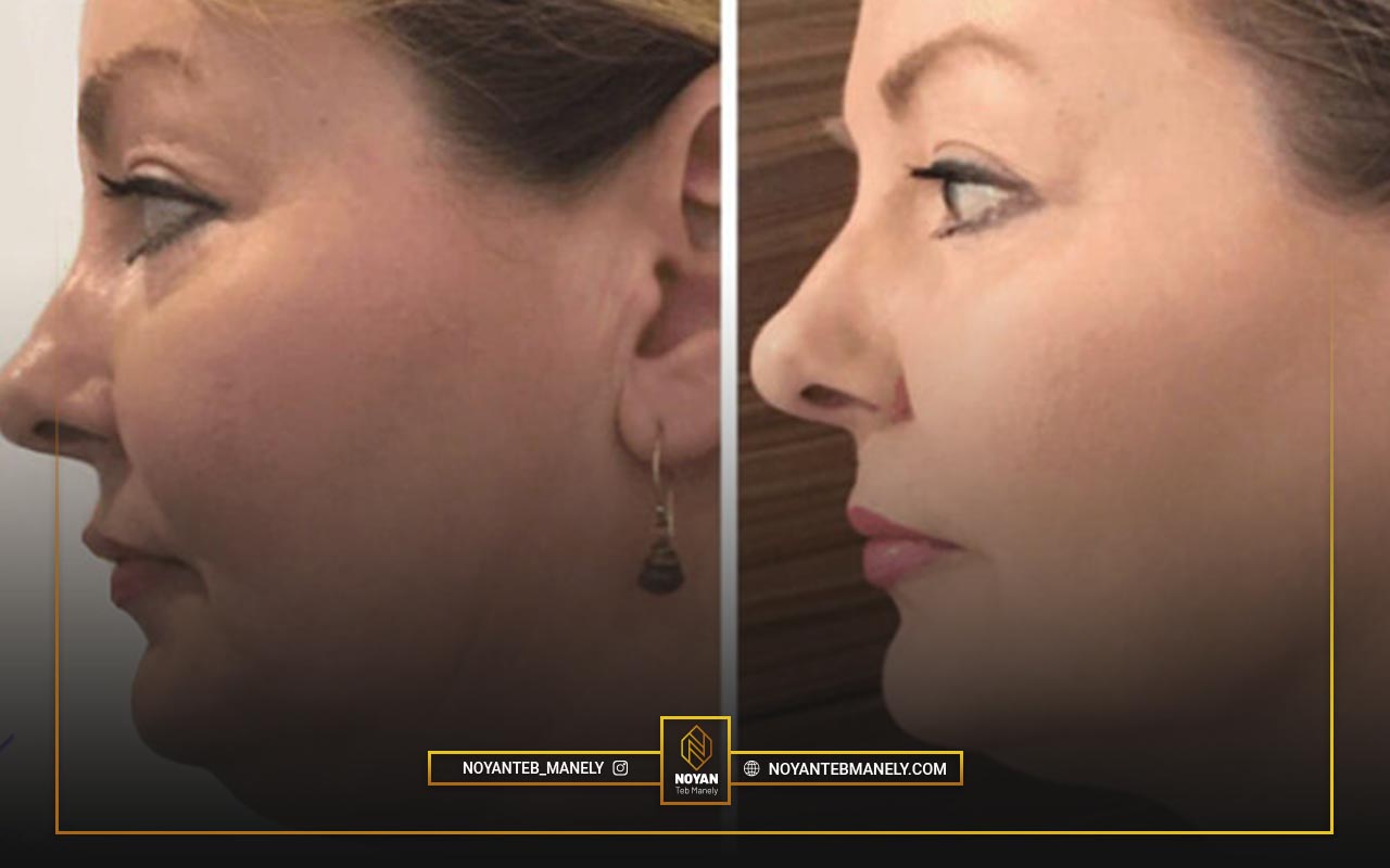 هایفو برای چه کسانی مناسب نیست؟