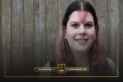 بهترین روش رفع لک های مادرزادی