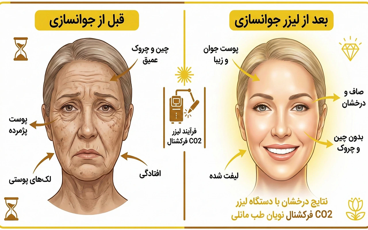 رفع چین و چروک صورت با لیزر