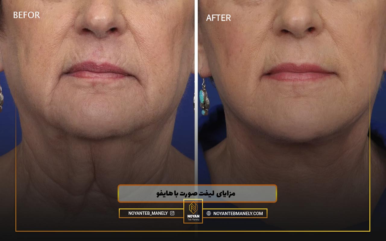 میکرونیدلینگ بهتر است یا هایفو ؟