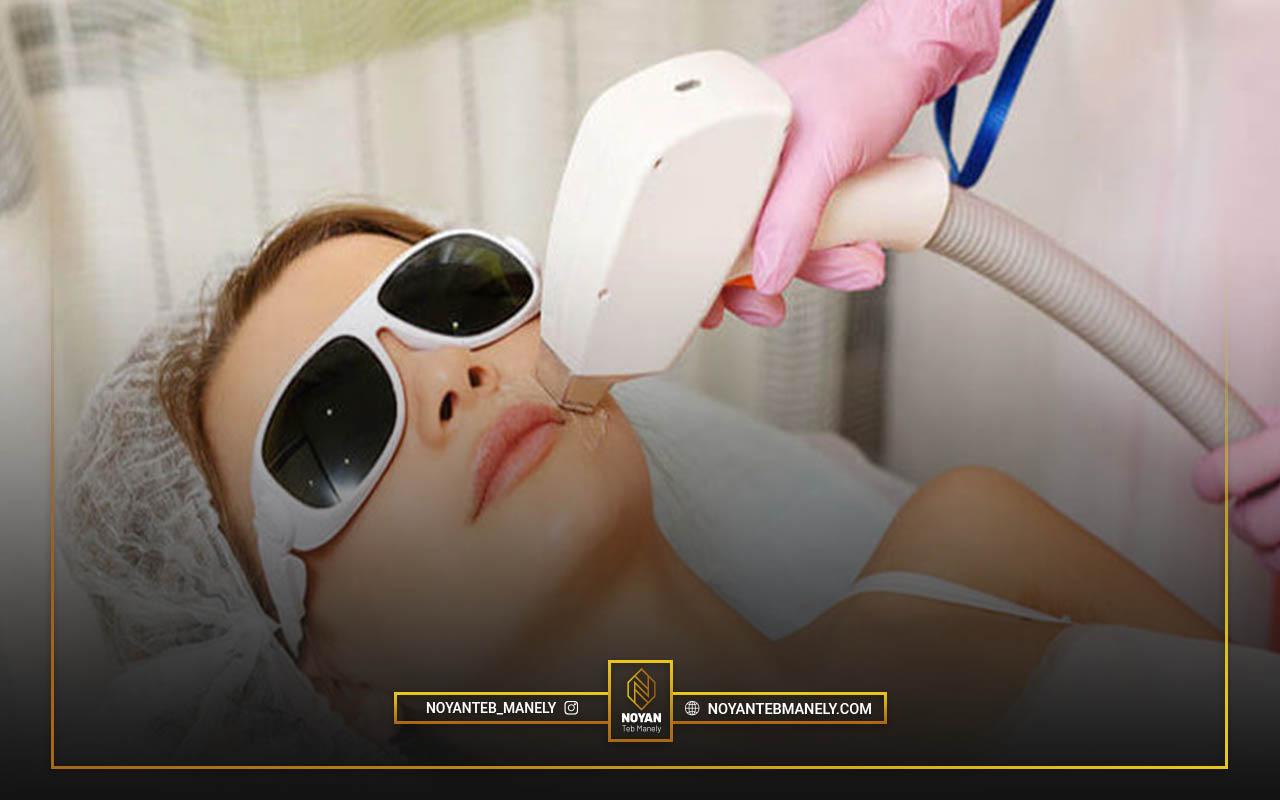 لیزر موهای صورت