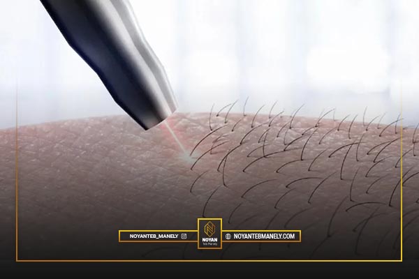 علت بازگشت موهای زائد بعد از لیزر