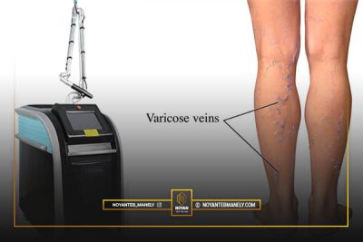 درمان واریس با لیزر کیوسوئیچ
