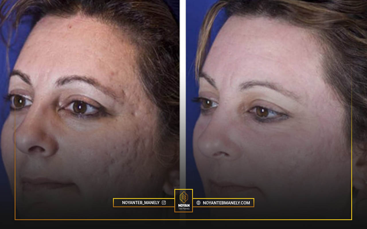 هزینه هر جلسه درمان با لیزر co2 فرکشنال