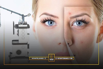 هزینه هر جلسه درمان با لیزر CO2 فرکشنال