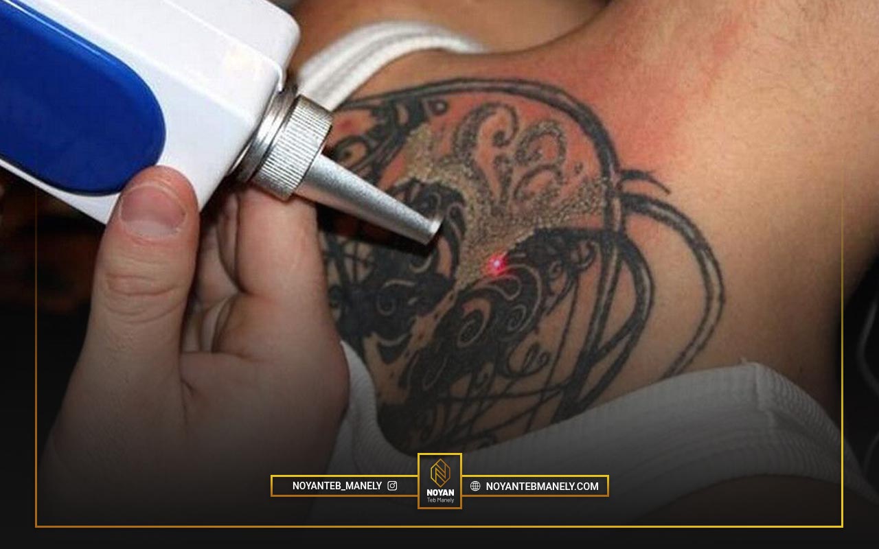 مقایسه دستگاه لیزر پیکوشور با دستگاه پیکوسکند