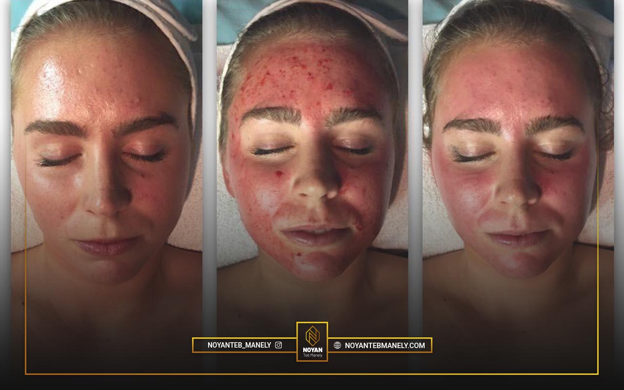 RF Fractional Vivace device