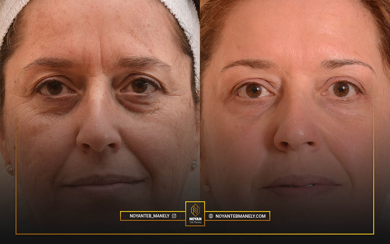 دوره نقاهت لیفت پوست با آر اف فرکشنال