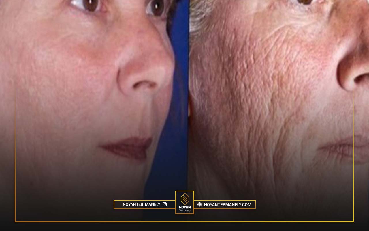 تفاوت های لیزر CO2 فرکشنال و RF فرکشنال