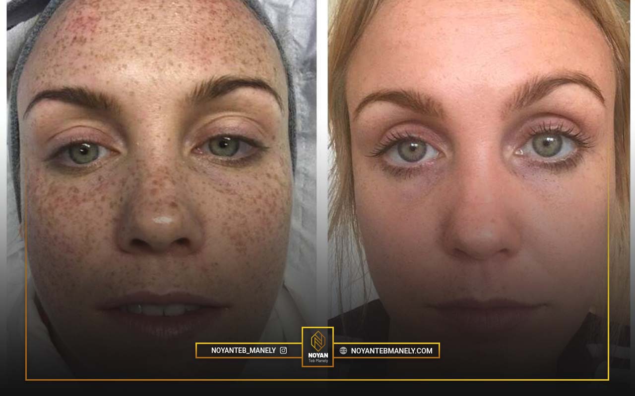 مقایسه دستگاه لیزر CO2 فرکشنال با دستگاه آر اف فرکشنال