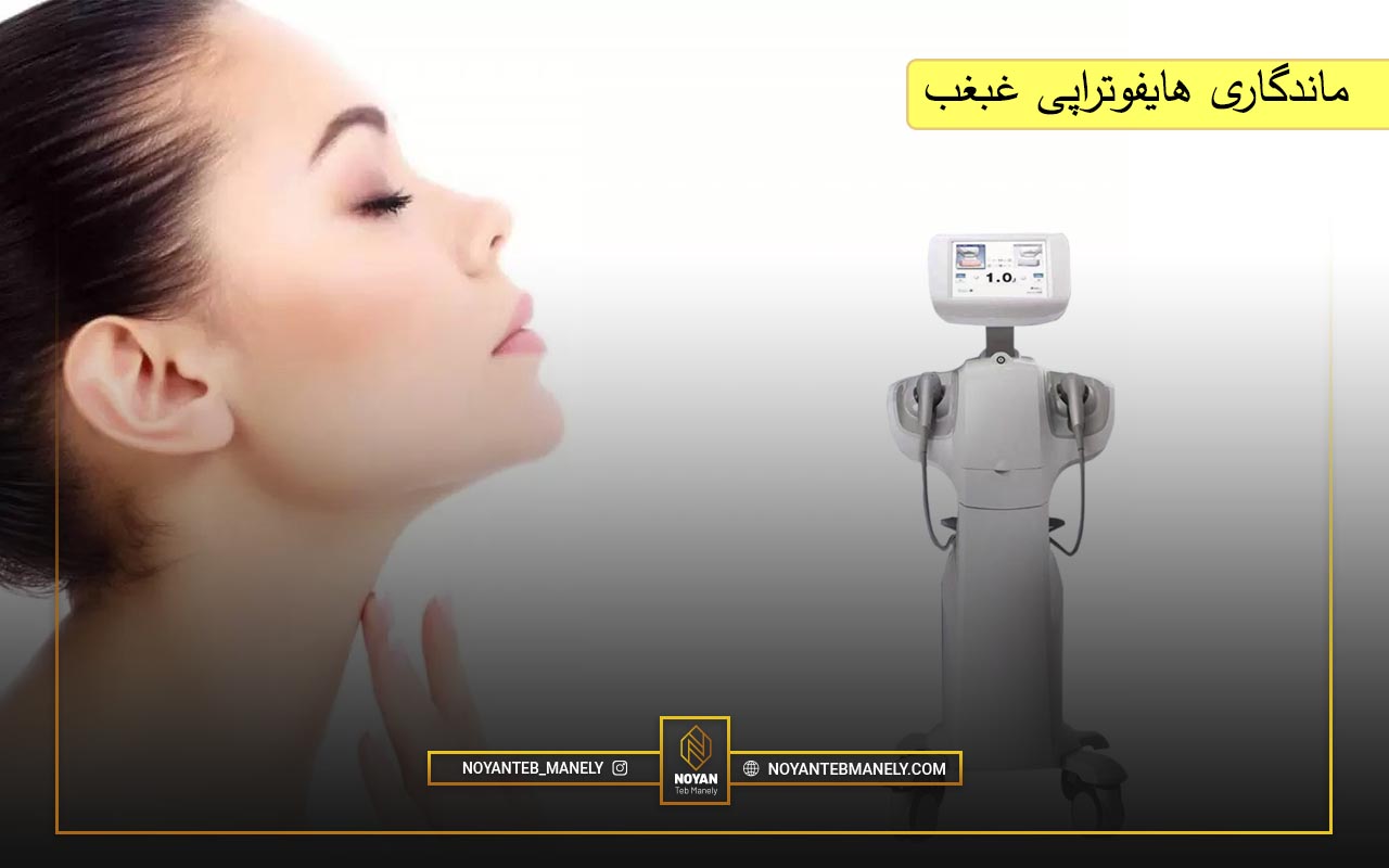 مدت ماندگاری هایفوتراپی غبغب