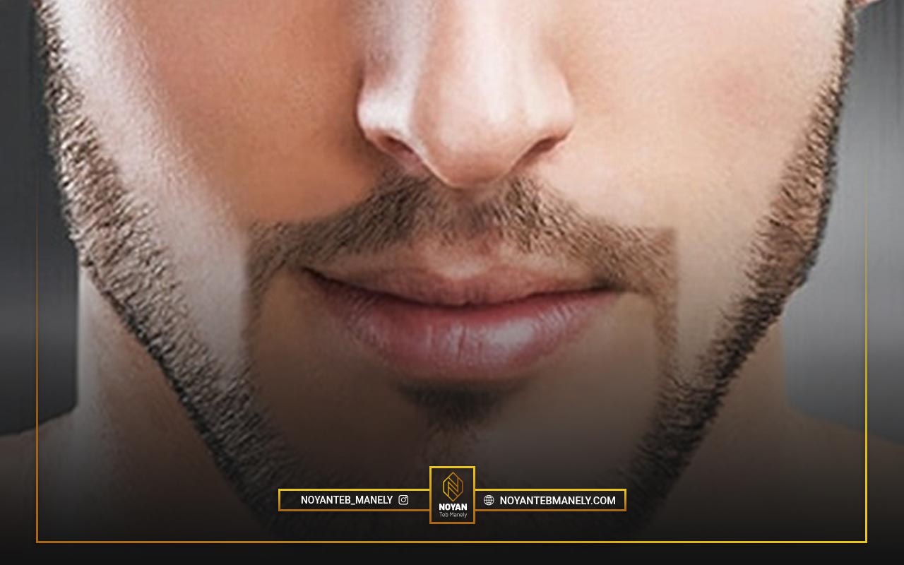 لیزر موهای زائد برای مردان