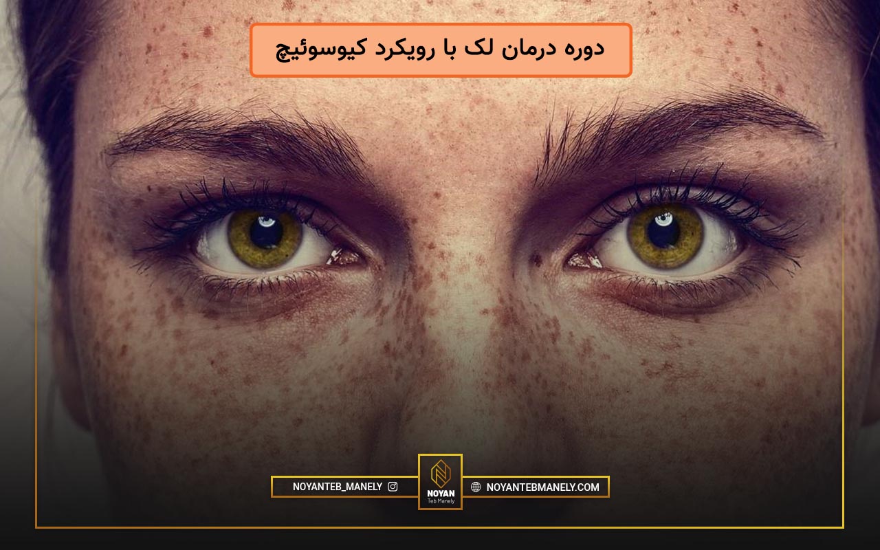 دوره درمان لک با رویکرد کیوسوئیچ