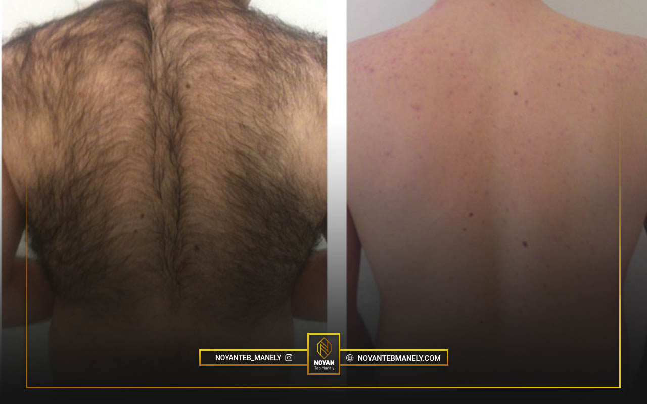 لیزر موهای زائد برای آقایان