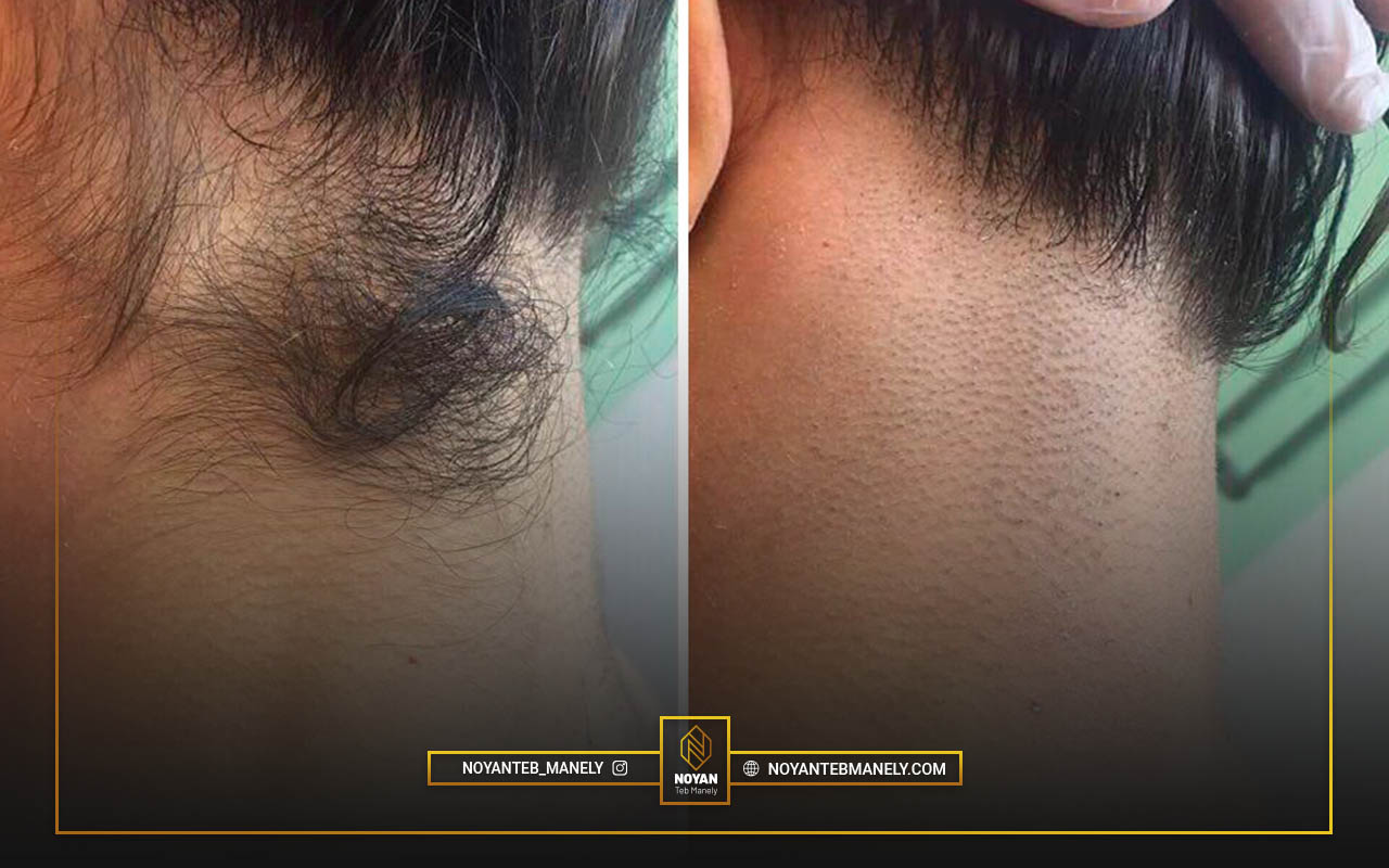 هزینه لیزر موهای زائد آقایان