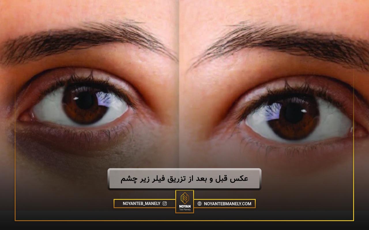 عکس فیلر زیر چشم