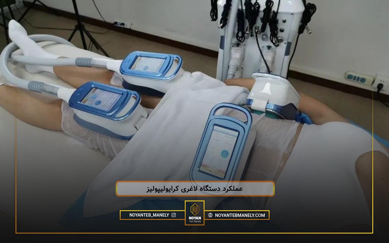 کرایو بهتر است یا ems؟