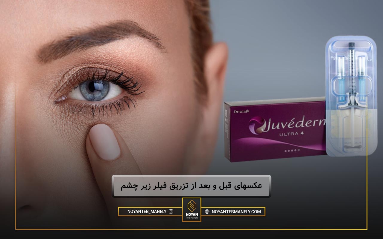 قیمت فیلر زیر چشم