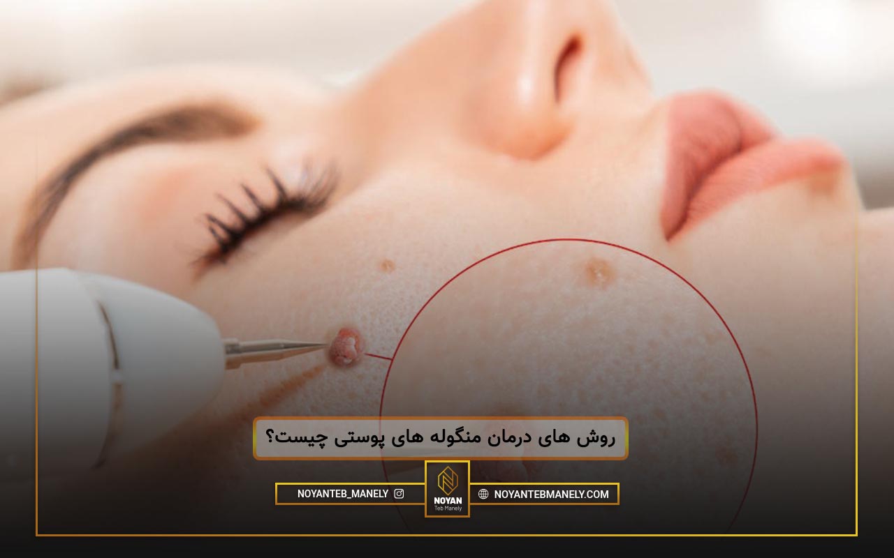 حذف منگوله پوستی با لیزر