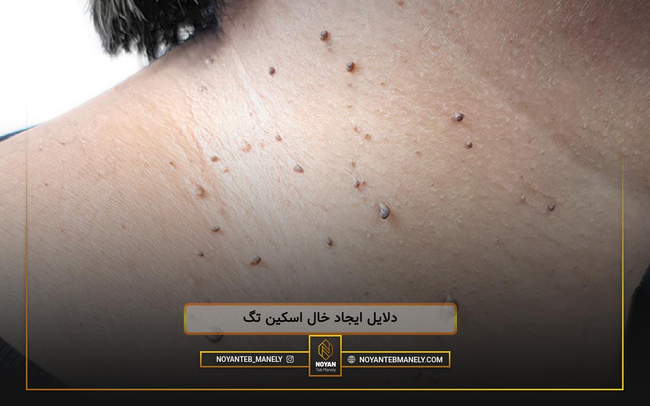 منگوله پوستی چیست؟