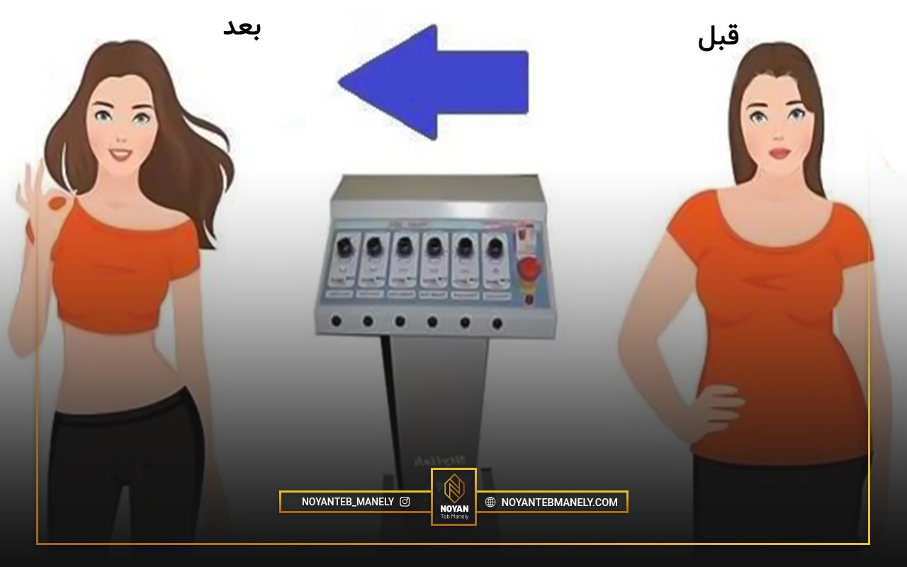 لاغری با دستگاه ترمودرمی