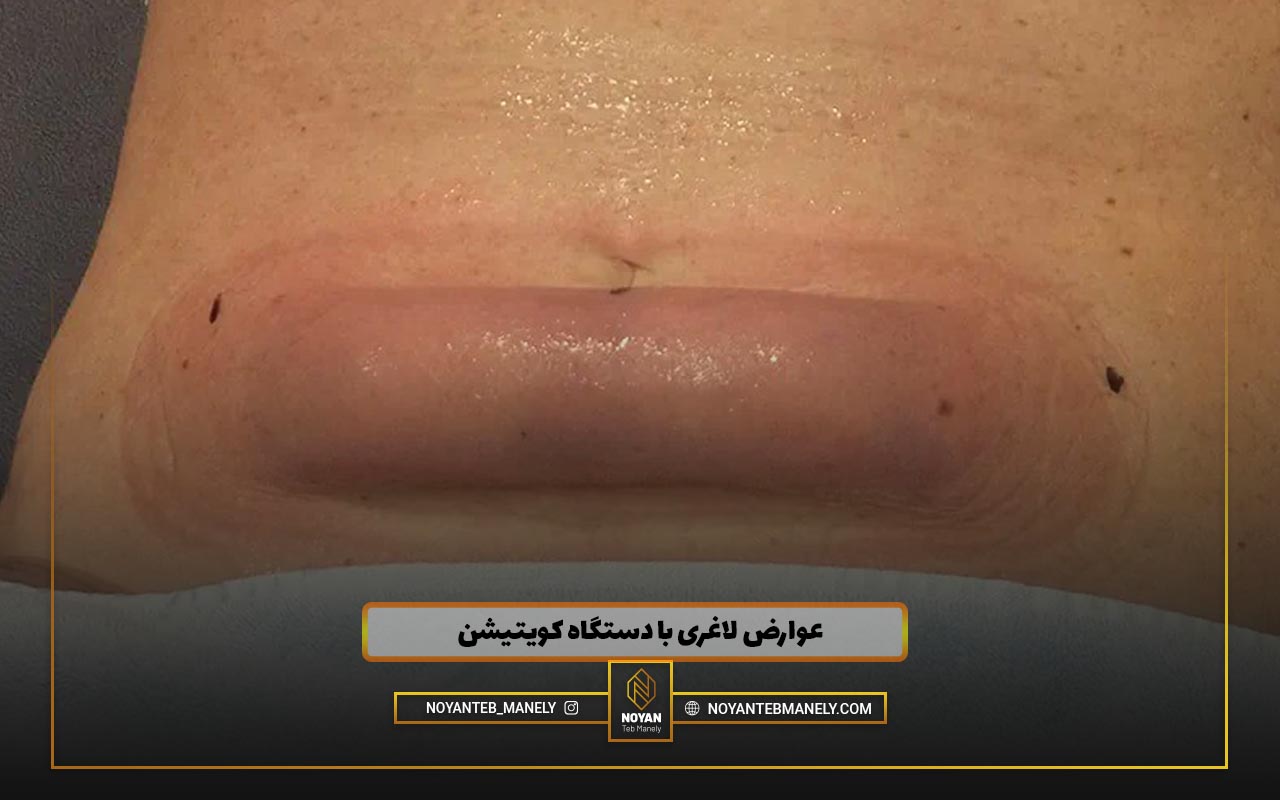 دستگاه لاغری کویتیشن عوارض