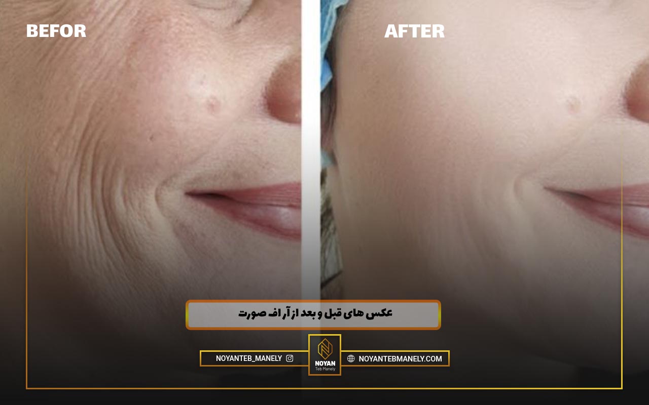 هزینه آر اف صورت