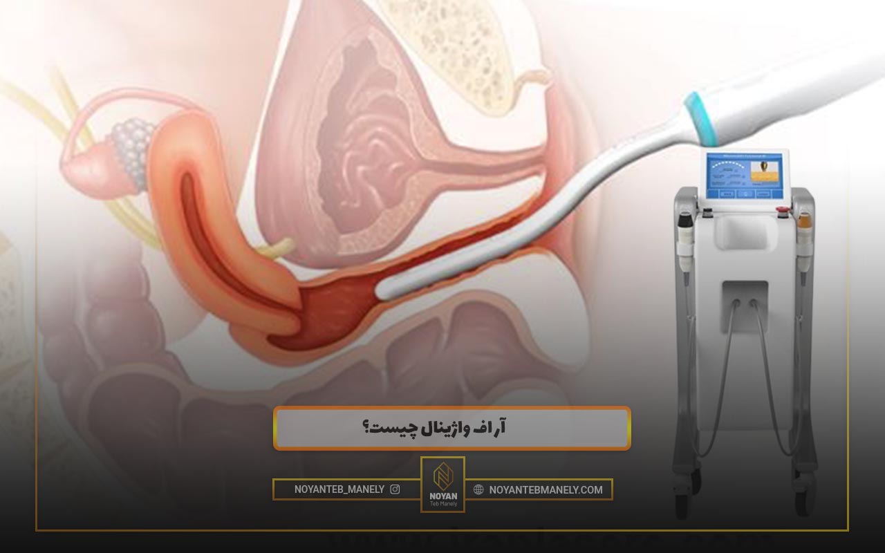 آر اف واژینال چیست