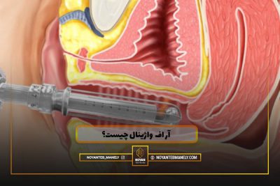 آر اف واژینال چیست؟