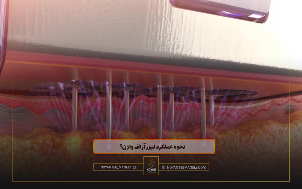 دستگاه آر اف واژینال