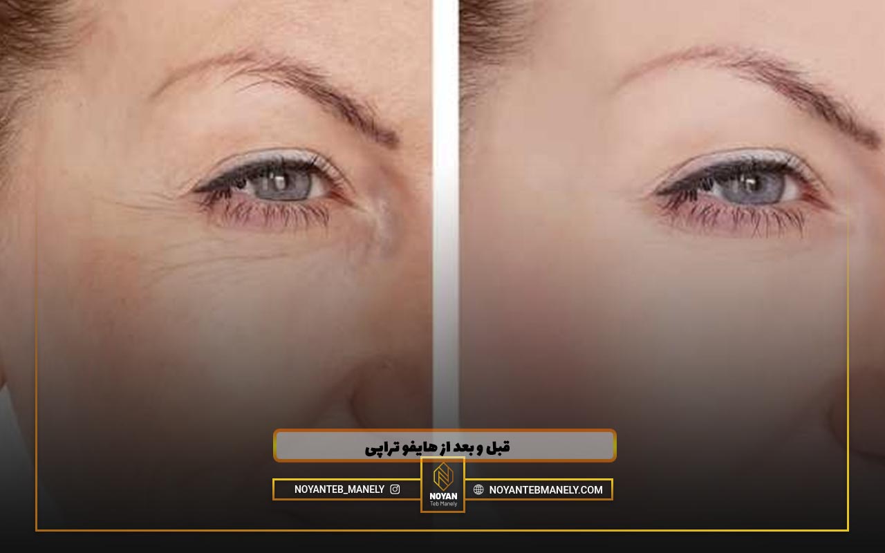 عکس های قبل و بعد از هایفو