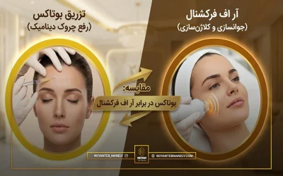 ماندگاری آر اف بیشتر است یا بوتاکس