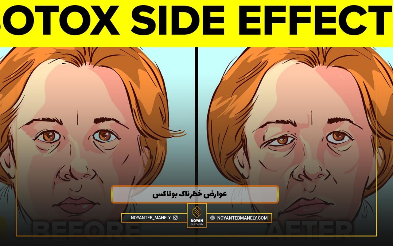 ایا بوتاکس عوارض دارد ؟