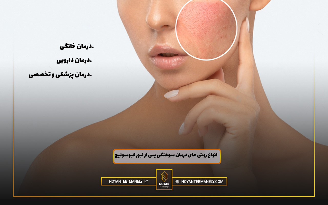 انواع روش های درمان سوختگی لیزر کیوسوئیچ